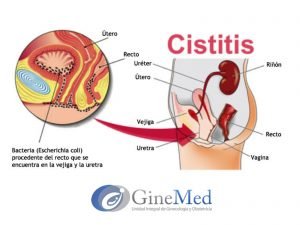 Cistitis
